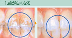 1.歯が白くなる