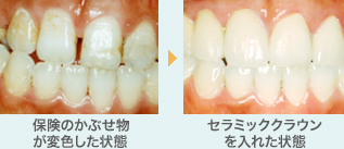 セラミッククラウン画像